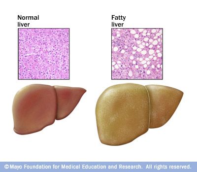 fatty liver disease
